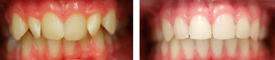 caso-exito-cerezuela-endodoncia